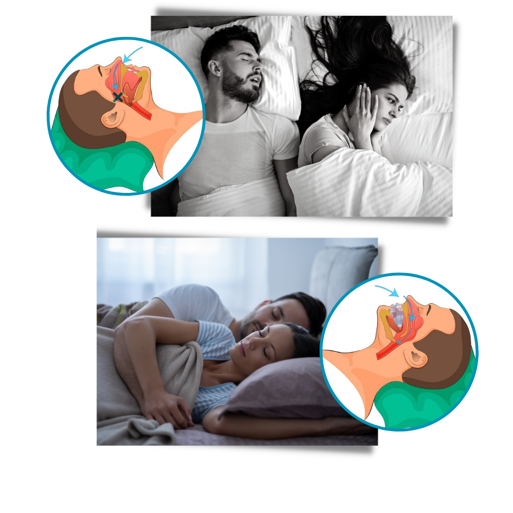 Advanced anti-snoring device - detail