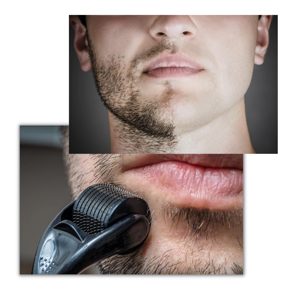 Dermal Roller For Hair And Beard Growth - detail